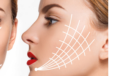 Fadenlifting ist die moderne Alternative zum klassischen Facelifting