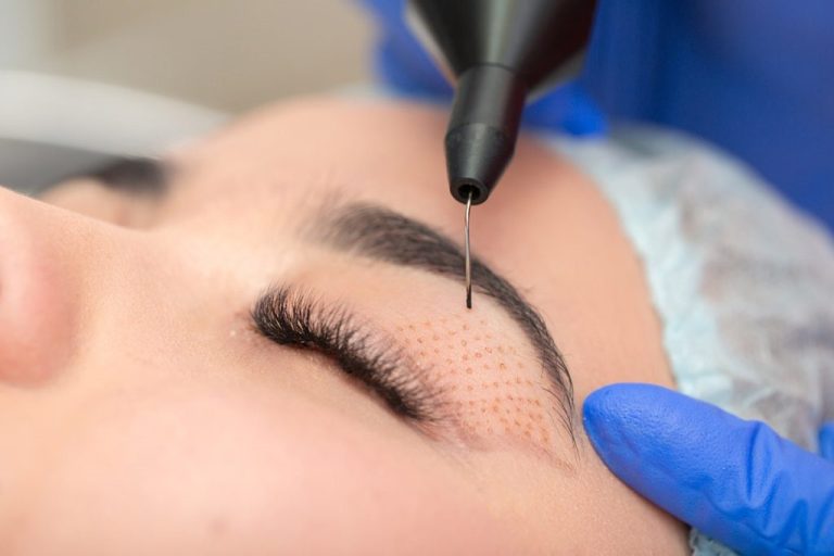 Plasma Pen Behandlung in Bonn – Sichtbare Lidstraffung ohne Operation