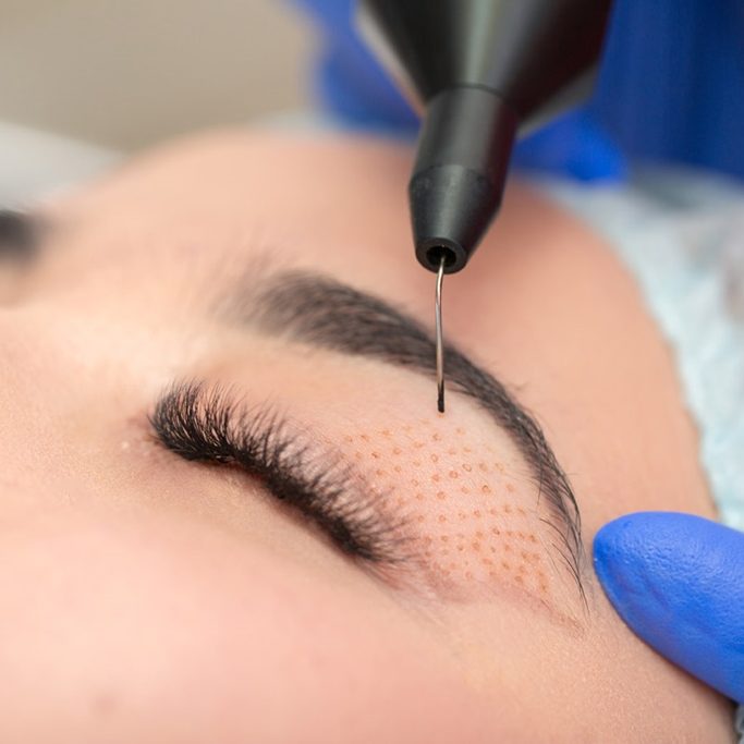 Die Plasma-Pen-Behandlung ist eine moderne, nicht-invasive Methode zur Straffung der Ober- und Unterlider (Schlupflider). 