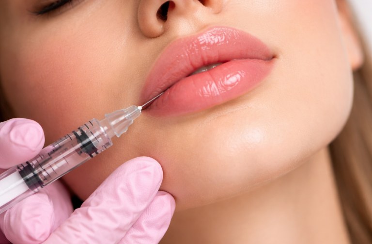 Lippenunterspritzung Bonn – Russian Lips, Swedish Technique oder klassisch. 